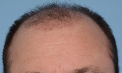 Hair Transplant Before & After Patient #4358