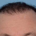 Hair Transplant Before & After Patient #4358