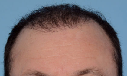 Hair Transplant Before & After Patient #4358