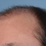 Hair Transplant Before & After Patient #4358