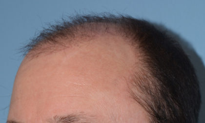 Hair Transplant Before & After Patient #4358