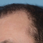 Hair Transplant Before & After Patient #4358