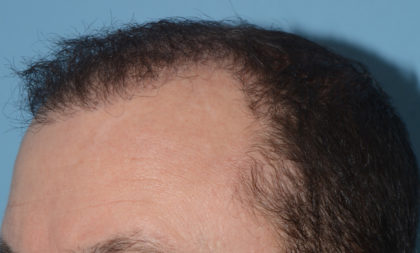 Hair Transplant Before & After Patient #4358