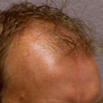 Hair Transplant Before & After Patient #4363