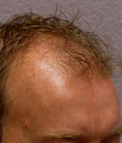 Hair Transplant Before & After Patient #4363
