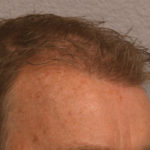 Hair Transplant Before & After Patient #4363