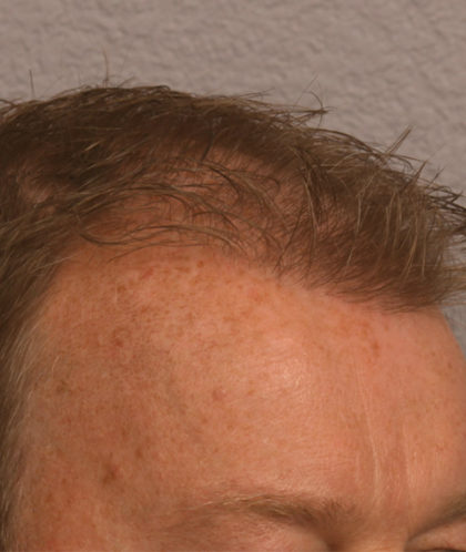 Hair Transplant Before & After Patient #4363