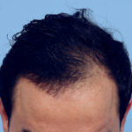 Hair Transplant Before & After Patient #4366