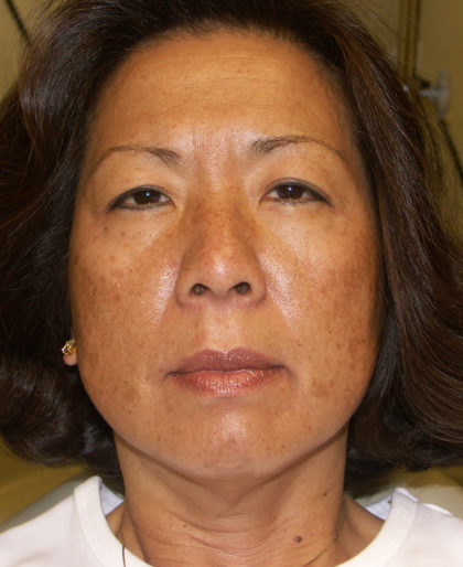 IPL Photorejuvenation Before & After Patient #4375