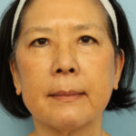 IPL Photorejuvenation Before & After Patient #4375