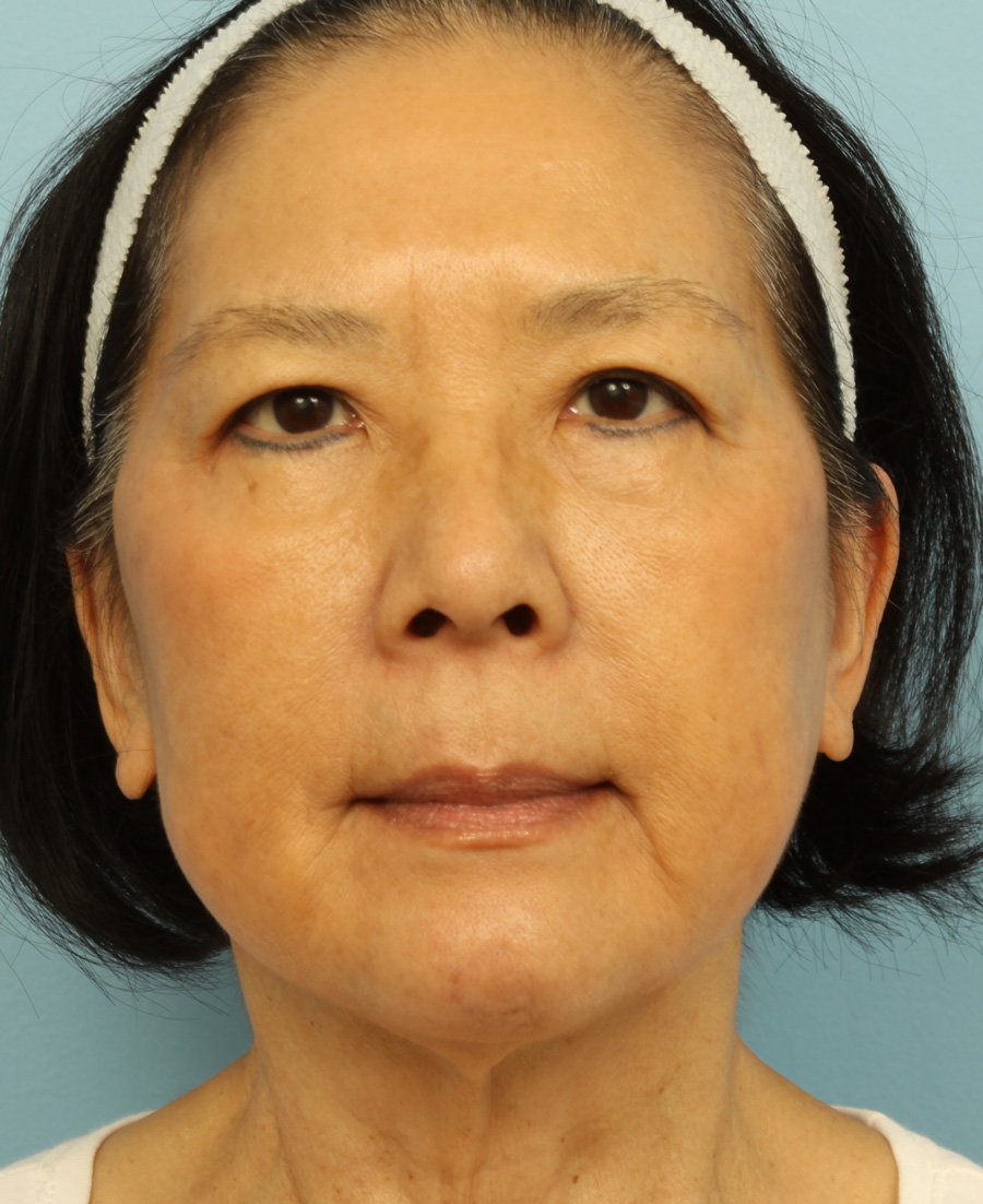IPL Photorejuvenation Before & After Patient #4375