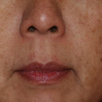 IPL Photorejuvenation Before & After Patient #4378