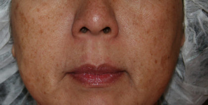 IPL Photorejuvenation Before & After Patient #4378