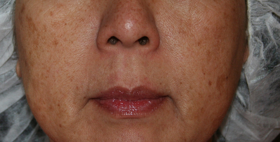 IPL Photorejuvenation Before & After Patient #4378