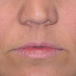 Juvederm Ultra Before & After Patient #4381