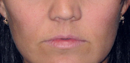 Juvederm Ultra Before & After Patient #4381