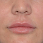 Juvederm Ultra Before & After Patient #4381