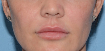 Juvederm Ultra Before & After Patient #4381