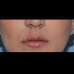 Juvederm Volbella Before & After Patient #4384