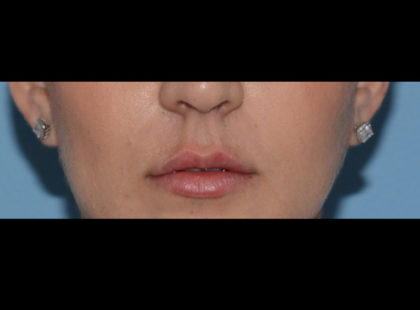 Juvederm Volbella Before & After Patient #4384