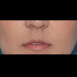 Juvederm Volbella Before & After Patient #4384
