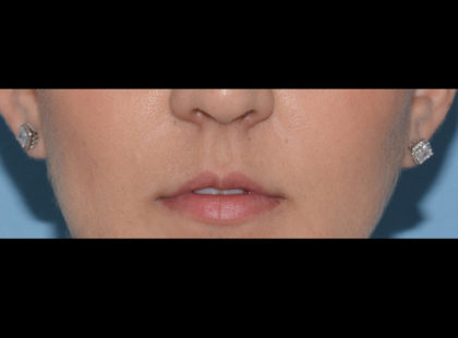 Juvederm Volbella Before & After Patient #4384