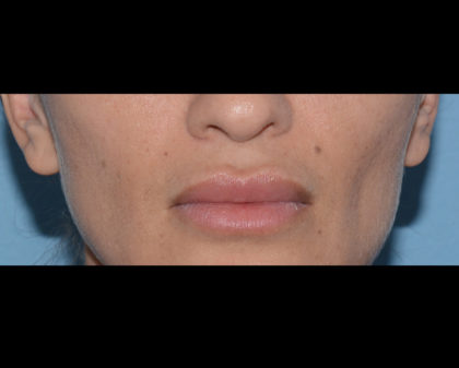 Cupid's Bow Before & After Patient #4428