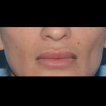 Juvederm Volbella Before & After Patient #4387