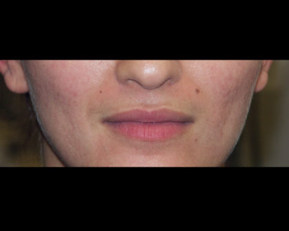 Cupid's Bow Before & After Patient #4428