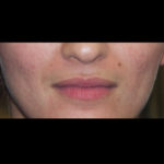 Juvederm Volbella Before & After Patient #4387