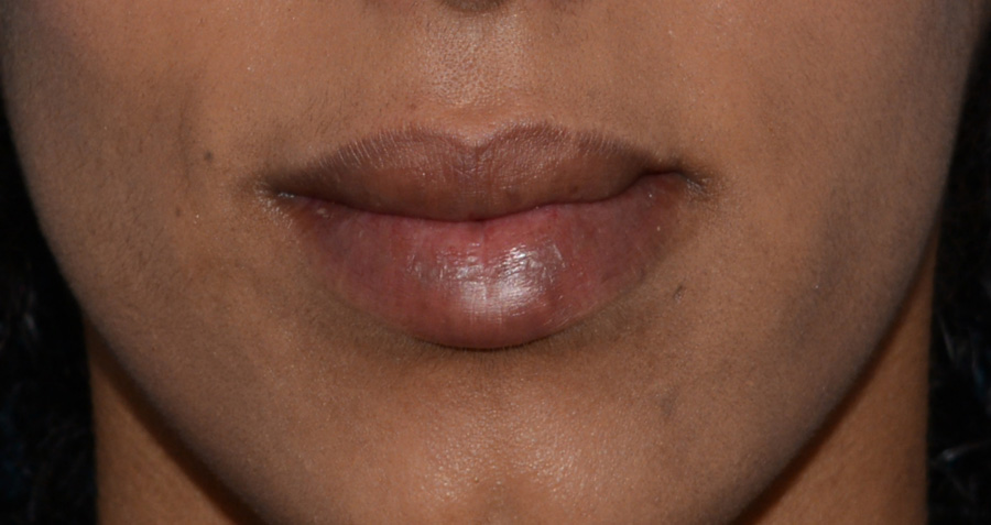Volumize Before & After Patient #4441