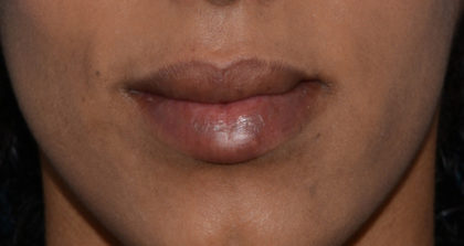 Cupid's Bow Before & After Patient #4431
