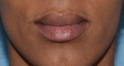 Cupid's Bow Before & After Patient #4431