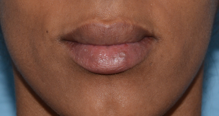 Cupid's Bow Before & After Patient #4431