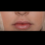 Juvederm Volbella Before & After Patient #4390