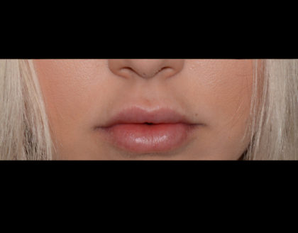 Juvederm Volbella Before & After Patient #4390