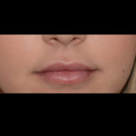 Juvederm Volbella Before & After Patient #4390