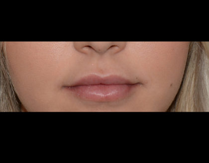 Juvederm Volbella Before & After Patient #4390