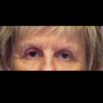 Lower Blepharoplasty Before & After Patient #4295