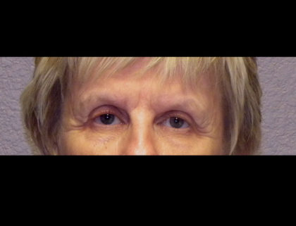 Lower Blepharoplasty Before & After Patient #4295