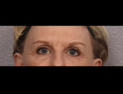 Lower Blepharoplasty Before & After Patient #4295