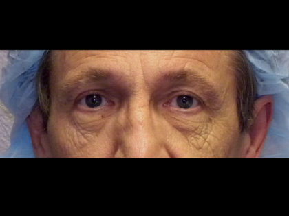 Lower Blepharoplasty Before & After Patient #4298