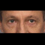 Lower Blepharoplasty Before & After Patient #4298