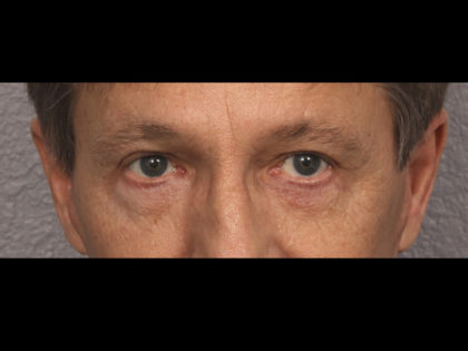 Lower Blepharoplasty Before & After Patient #4298