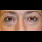 Blepharoplasty Before & After Patient #4301