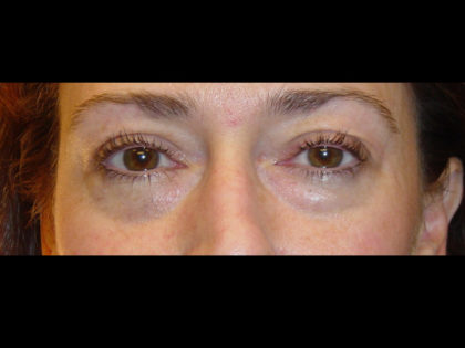 Blepharoplasty Before & After Patient #4301