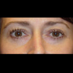 Blepharoplasty Before & After Patient #4301