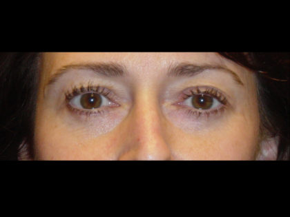 Blepharoplasty Before & After Patient #4301