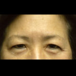 Lower Blepharoplasty Before & After Patient #4304