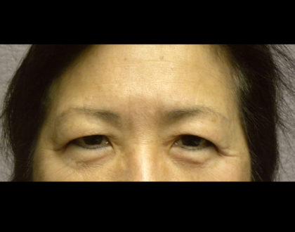 Lower Blepharoplasty Before & After Patient #4304